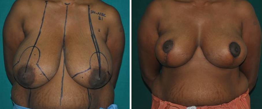 Breasts reduction surgery in Cochin, India